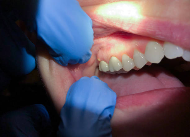 Best Knocked-Out Tooth (Avulsed Tooth) Treatment in Port Washington, NY